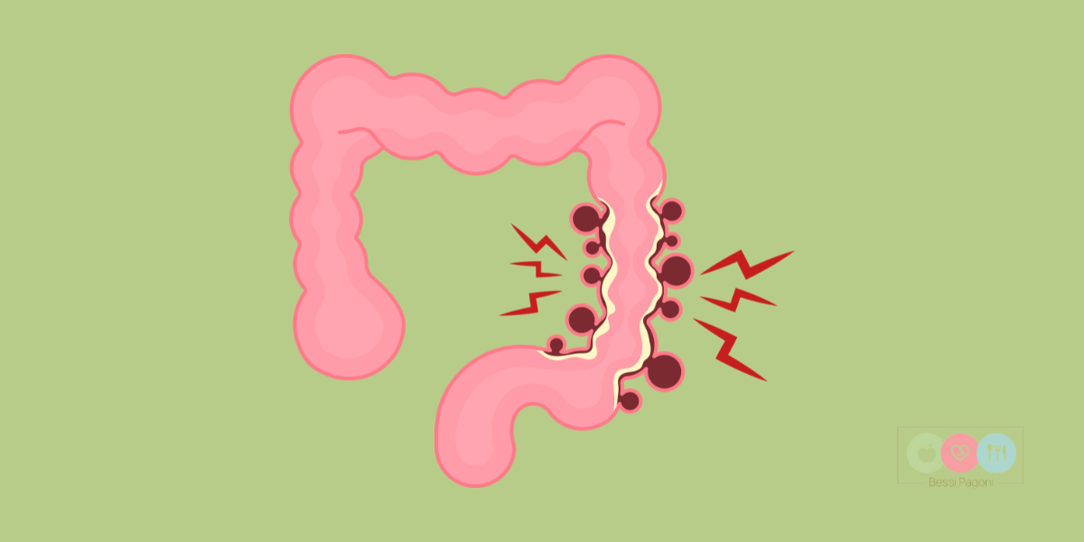Σύνδρομο ευερέθιστου εντέρου και διατροφή